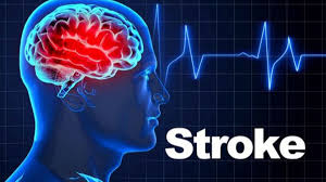 Stroke Treatment Specialist